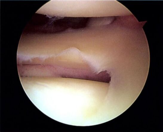 Meniscus tear leading to osteoarthritis of the knee