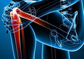 Knee pain in arthritis and arthrosis