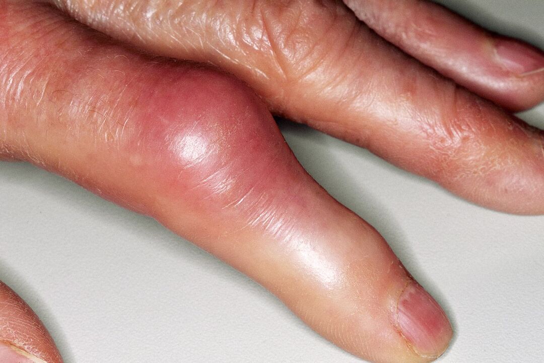 Swelling, deformation of the finger joint and acute pain after an injury