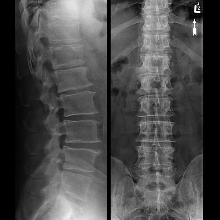 Sncing of the spine with osteochondrosis