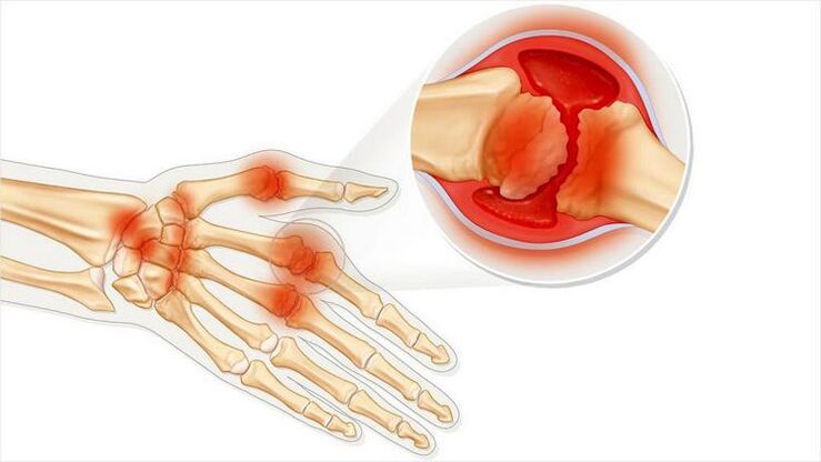 Damage to the wrists due to arthritis