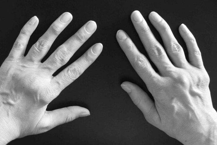 Symptoms of arthritis in the joints of the hands