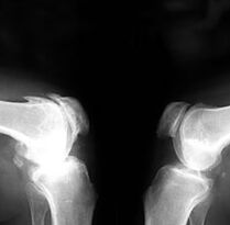 Osteoarthritis on x-rays