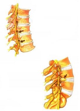 Illustration of spinal osteochondrosis